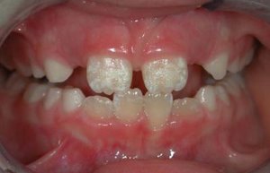 Гипоплазия эмали прорезавшихся зубов фото