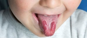 Симптомы глоссита языка