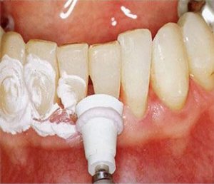 Поилировка зубов после снятия зубных отложений
