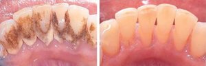 До и после снятие зубного камня фото