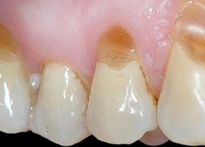V-образные клиновидные дефекты в области шеек трех верхних зубов