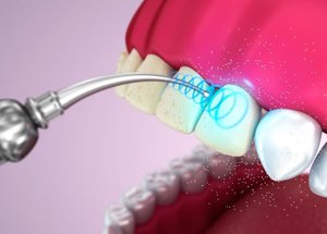 Ультразвкковая читска зубов